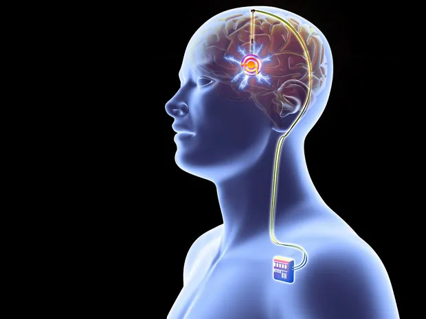 Deep Brain Stimulation for Severe Opioid Addiction